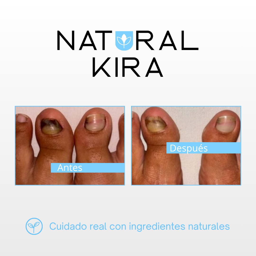 Crema para Hongos de los PIES - 50ml