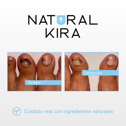 Crema para Hongos de los PIES - 50ml