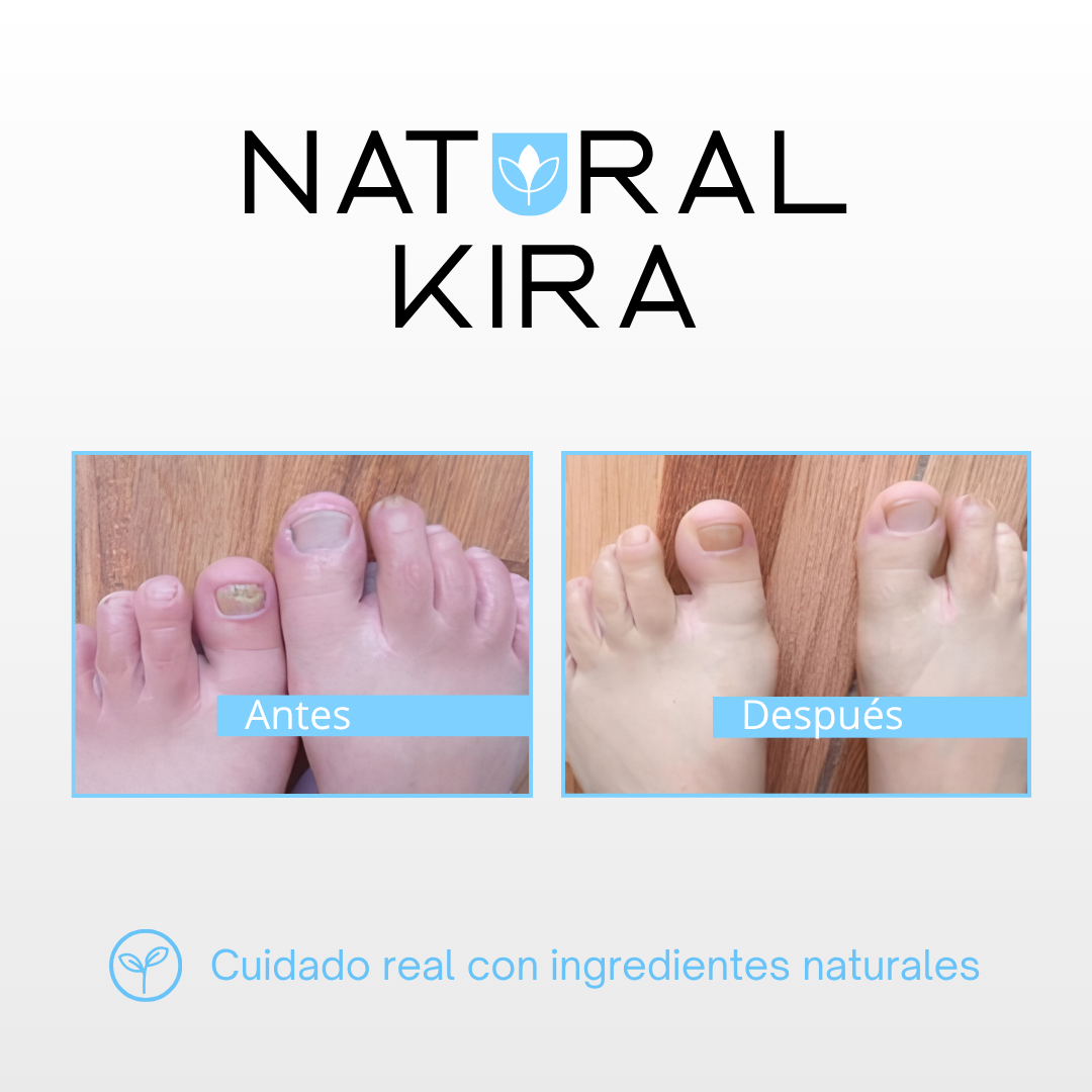 Crema para Hongos de los PIES - 50ml